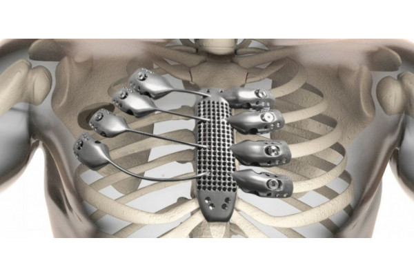 Impression 3D Titane Applications Médicales